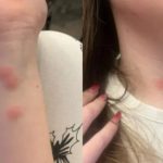 o tanara a ajuns la spital dupa ce a fost muscata de plosnite intr un tren cfr 69232b3b64a0a