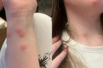 o tanara a ajuns la spital dupa ce a fost muscata de plosnite intr un tren cfr 69232b3b64a0a