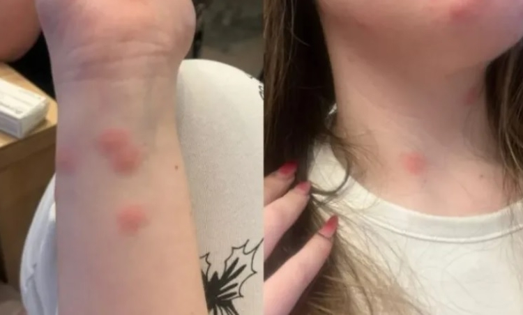 o tanara a ajuns la spital dupa ce a fost muscata de plosnite intr un tren cfr 69232b3b64a0a