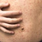 oms avertizeaza asupra reaparitiei ingrijoratoare a rujeolei in multe regiuni ale lumii inclusiv in europa 692b5d024d136