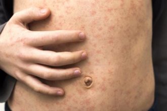 oms avertizeaza asupra reaparitiei ingrijoratoare a rujeolei in multe regiuni ale lumii inclusiv in europa 692b5d024d136