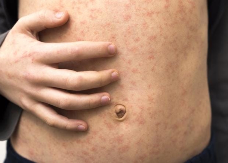 oms avertizeaza asupra reaparitiei ingrijoratoare a rujeolei in multe regiuni ale lumii inclusiv in europa 692b5d024d136