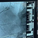 performanta medicala 100 de interventii coronariene realizate la scju constanta 69147986ecb99