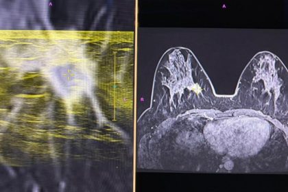 foto premiera nationala la spitalul judetean constanta prima punctie mamara ecoghidata cu fuziune de imagini irm 698ec4665e646