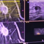 spitalul judetean constanta o noua premiera nationala prima punctie mamara ecoghidata cu fuziune de imagini irm 698dee7d4543d