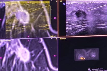 spitalul judetean constanta o noua premiera nationala prima punctie mamara ecoghidata cu fuziune de imagini irm 698dee7d4543d